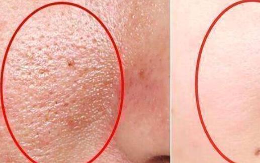 毛孔粗大用食鹽有用嗎 毛孔粗大敷什么面膜好