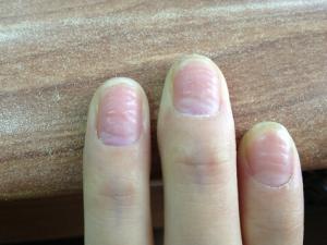 如何預(yù)防手指甲凹凸不平?手指甲凹凸不平的危害