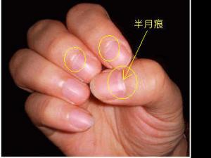 指甲上的半月痕你懂多少?指甲半月痕與健康吉兇