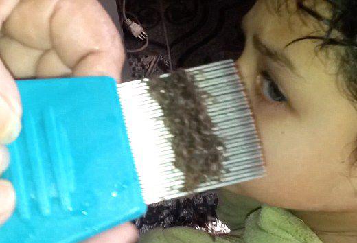 頭上長虱子怎么辦?虱子怎么去除?去虱子和虱子卵的有效方法