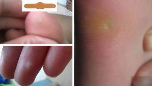 雞眼剛開始的圖片及初期癥狀、雞眼的形成原因及治療方法