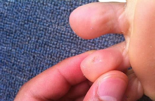 雞眼剛開始的圖片及初期癥狀、雞眼的形成原因及治療方法