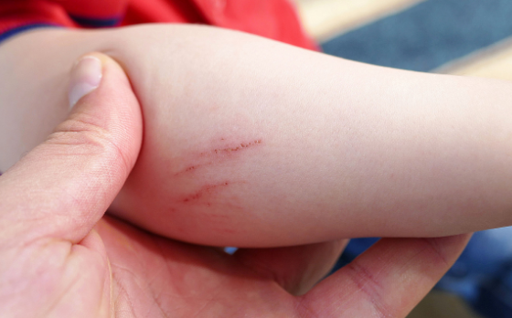 海鮮過敏怎么辦?吃完海鮮不能吃哪些食物?