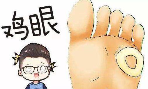 ?雞眼是什么?雞眼形成的原因有哪些?