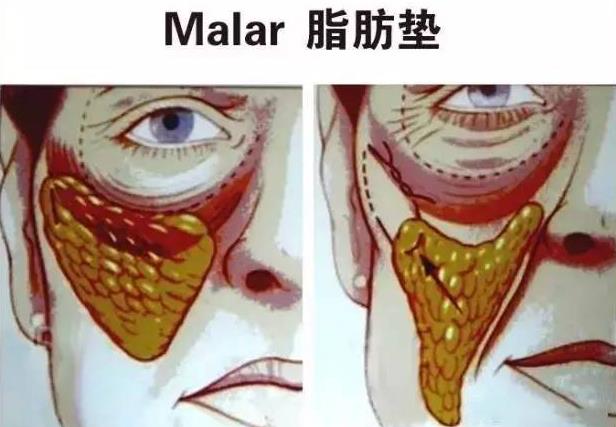 抗衰醫生宋超超:提升面部脂肪墊和SMAS筋膜層的優勢