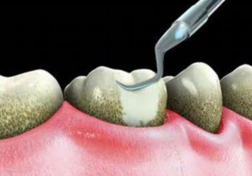 牙結(jié)石可以自己扣掉嗎?牙結(jié)石怎么才可除去?