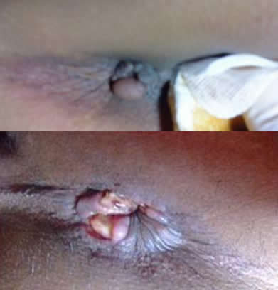 女性痔瘡真人實(shí)拍圖片 網(wǎng)上曝光的7個小偏方有效治痔瘡 女性痔瘡真人實(shí)拍圖片:網(wǎng)上曝光的7個小偏方有效治痔瘡