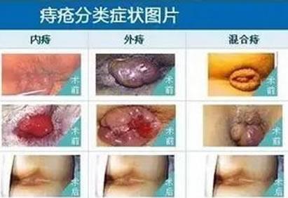 女性痔瘡真人實(shí)拍圖片 網(wǎng)上曝光的7個小偏方有效治痔瘡