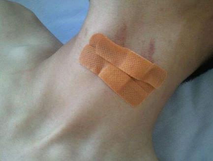 種草莓 除吻痕.jpg