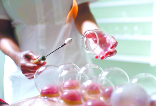 拔火罐能減肥嗎？拔火罐減肥有用嗎