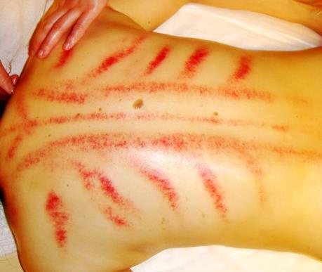 哪些人不適合刮痧？刮痧有什么禁忌