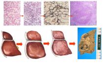 如何預(yù)防脂肪肝？注意哪些習(xí)慣？