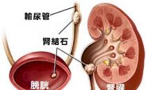 如何預防泌尿系結石 ?