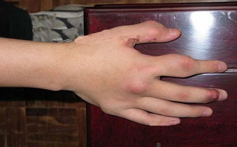 風(fēng)濕性關(guān)節(jié)炎