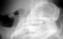 太嚇人，82歲老太太查出竟懷孕40年