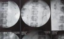 男子體內長四個腎，可以買腎6了