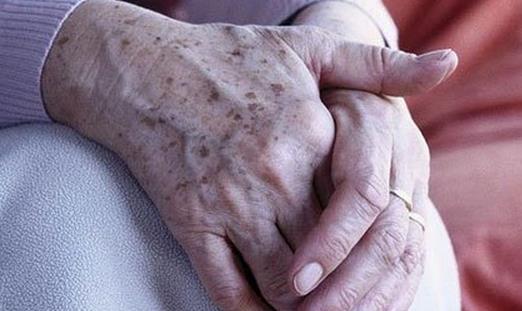 老年斑的消除方法?三招教你去除老年斑