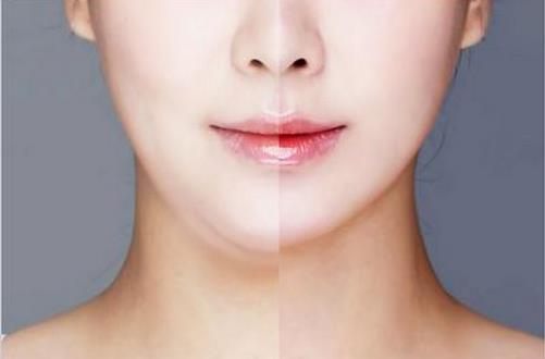 關于面部吸脂術你了解多少