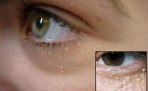 粒粒皆辛苦？找準原因輕松治脂肪粒！