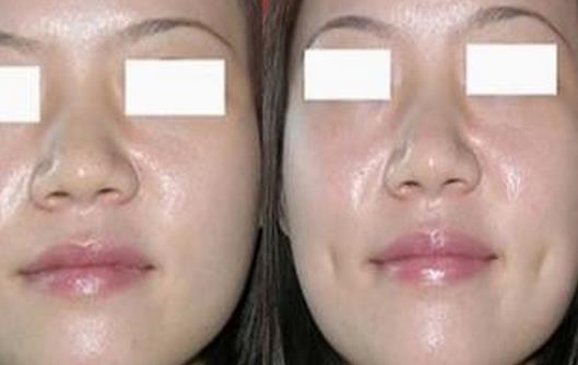 人造酒窩的切口有多大?