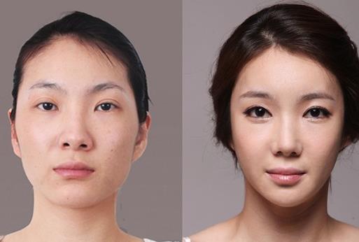 顴骨整形手術有什么優勢呢