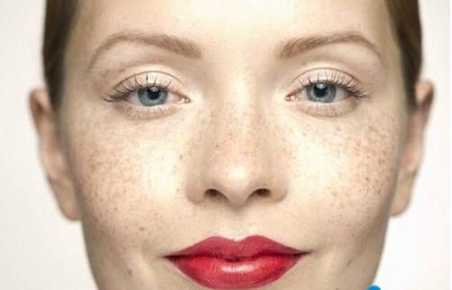 OPT強(qiáng)脈沖光去雀斑