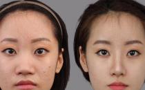 鼻翼整形術前6大禁忌 不可忽視