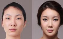 顴骨整形手術有什么優勢呢