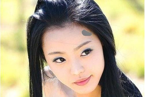 治療胎記防上當 色素治療得不償失