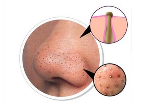 有效地去黑頭方法 細(xì)鹽去黑頭步驟