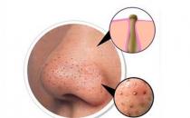 有效地去黑頭方法 細鹽去黑頭步驟