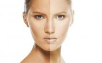 祛痘護理方法 養護痘痘肌的秘密