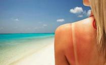 皮膚曬傷后應該如何急救？