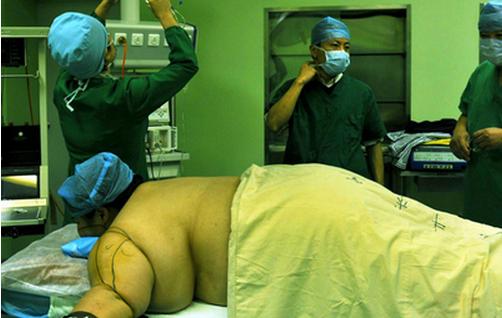 抽脂的5個秘密不可不知道