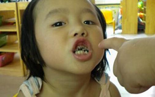 斷奶太晚寶寶易發生齲齒
