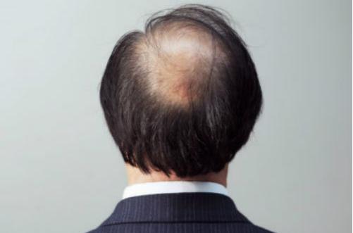 想要遠離脫發 男人要做持久戰