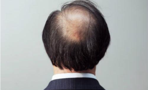 男人為什么更容易掉頭發