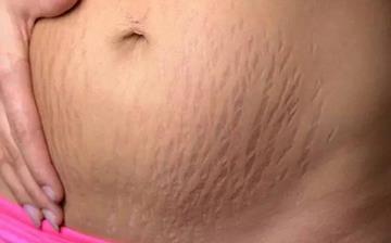 【妊娠紋】怎樣去妊娠紋小竅門_孕婦妊娠紋圖片_有什么辦法去掉妊娠紋