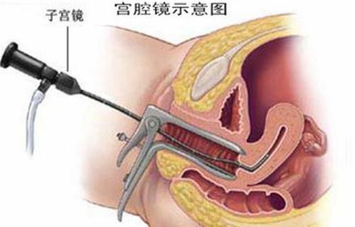 正確使用宮腔鏡 患有哪些疾病不可用宮腔鏡