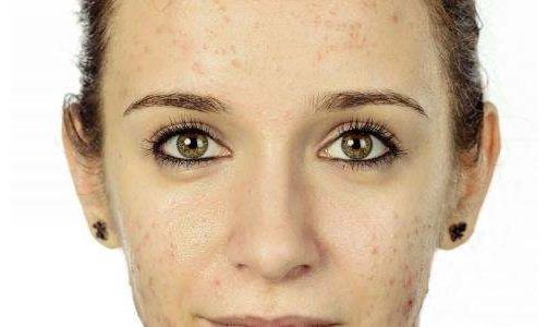 皮膚出油是缺水嗎？皮膚出油怎么辦