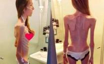 ? 女孩1米8重30公斤 厭食癥的危害