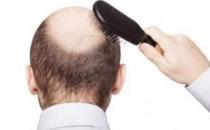 想要遠離脫發 男人應做持久戰