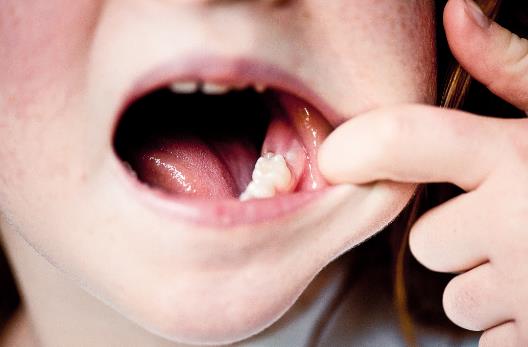 不同體質對癥食療治磨牙