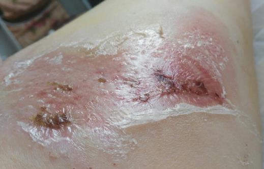 燙傷后護理很重要 水泡要不要挑破