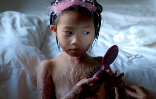 燙傷后護理很重要 水泡要不要挑破