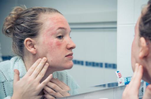 濕疹的危害不能忽視預防做好這幾點