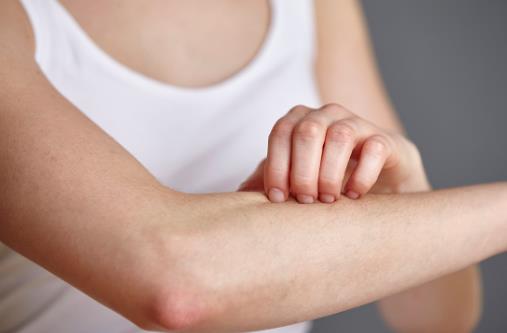 濕疹的危害不能忽視預防做好這幾點