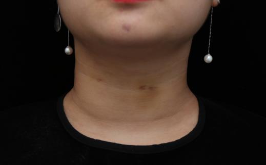 如何去除頸紋 七個方法塑造光滑頸部