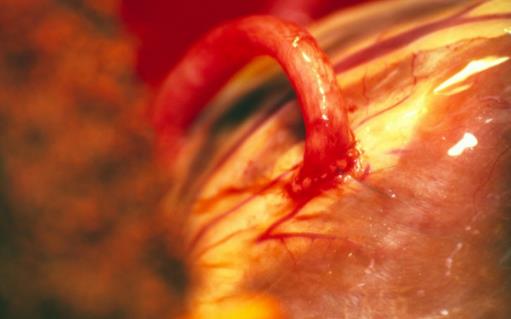 發(fā)熱咽痛是心肌炎早期癥狀 預(yù)防心肌炎需要適當(dāng)休息