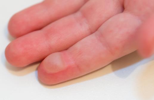 手指無緣無故起小水泡 忌食刺激性食物預防治療水泡 